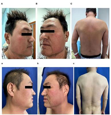 Sulfasalazine-induced drug reaction with eosinophilia and systemic symptoms (DRESS) coinfected with COVID-19 complicated by hemophagocytic lymphohistiocytosis: a case report